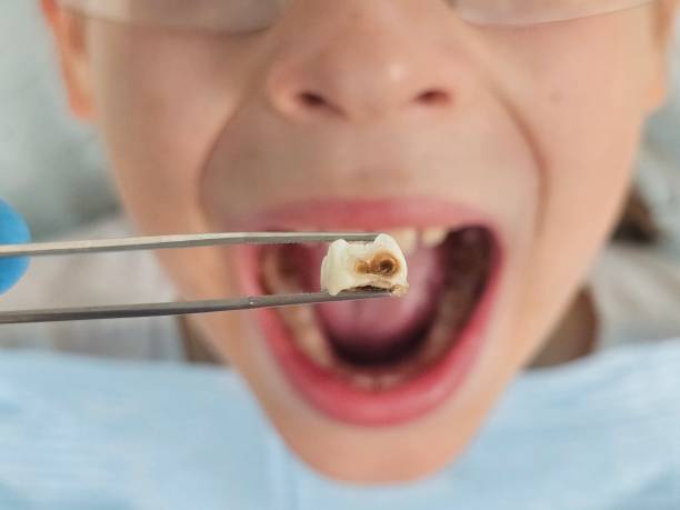 Best Emergency Wisdom Tooth Extraction in Belleair, FL